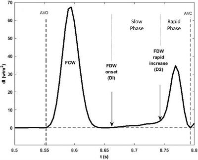 Mechanisms of Aortic Flow Deceleration and the Effect of Wave Reflection on Left <mark class="highlighted">Ventricular Function</mark>